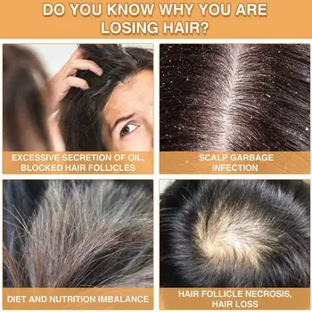 30ml 7X Rýchly Rast Vlasov Liečba Anti Hair Loss Rýchly Rast Vlasov Sérum Zázvor Esenciálny Olej Pre Pokročilých Rednutie Vlasov