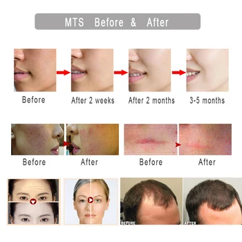 Derma valček DRS540 Mezoroller Mikro Ihly Tvár Starostlivosť o Pleť opätovný rast Vlasov Rastu Brady Anti Hair Loss Treatment Rednutie Ustupujúce