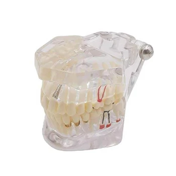 Nové Zubné Model Zubov Implantát Obnova Mosta Výučby Štúdia Lekárske Vedy Choroby Stomatológia Stomatológia Produkty