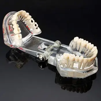 Nové Zubné Model Zubov Implantát Obnova Mosta Výučby Štúdia Lekárske Vedy Choroby Stomatológia Stomatológia Produkty