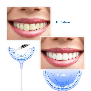 Tongwode zubné whitener 3 ks hands-free na bielenie zubov urýchľovač časovej funkcie biele zuby nástroj