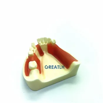 Zubné Dolnej Čeľuste Gingiva Implantát Praxi model chýbajúcich zubov zubný lekár vzdelávacie študent štúdium zuby vykonávať model